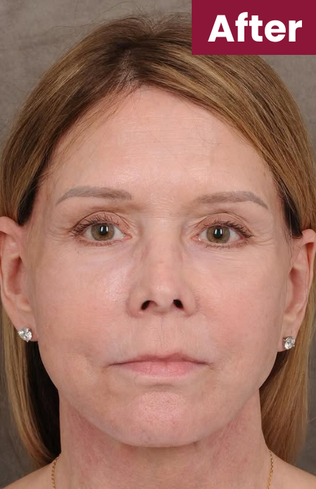 Anti-Wrinkle Collagen Mask 35 After 6